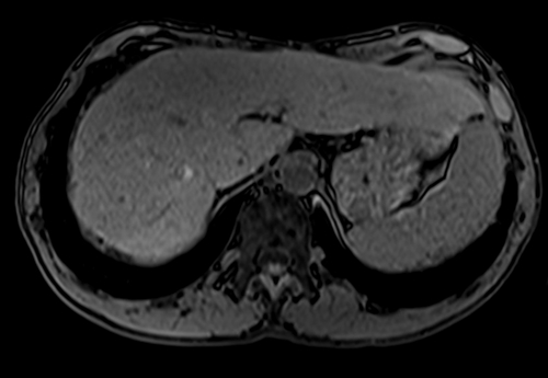 MRI kidneys t1 vibe coronal pre contrast image 