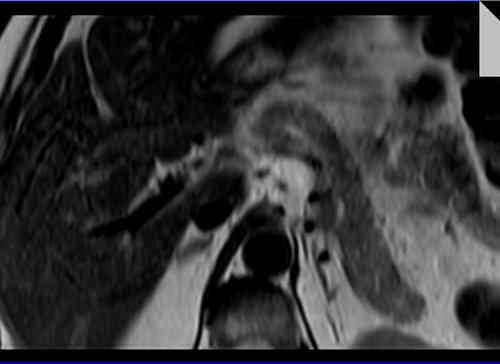  PANCREAS MRI T2 AXIAL IMAGES