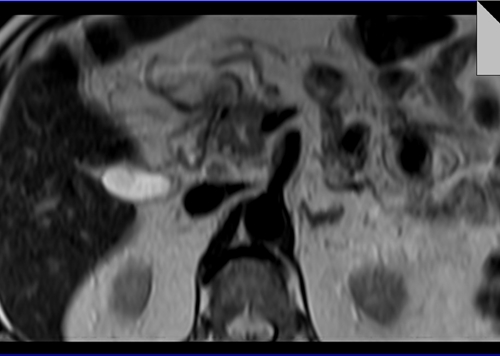  PANCREAS MRI T2 AXIAL IMAGES