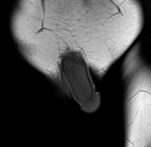 mri penis coronal  t1 small fov  image