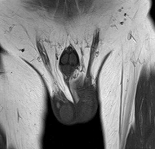 mri penis coronal  t1 small fov  image