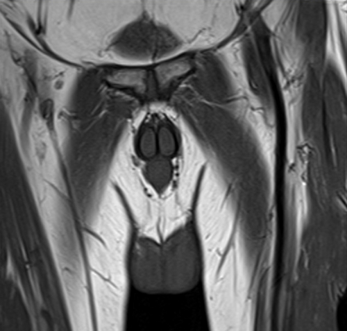 mri penis coronal  t1 small fov  image