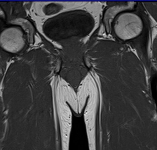 mri penis coronal  t1 small fov  image