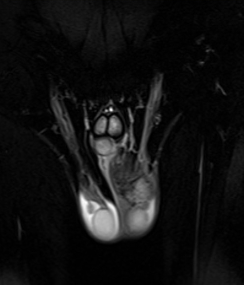 mri penis coronal  t2 stir  image 