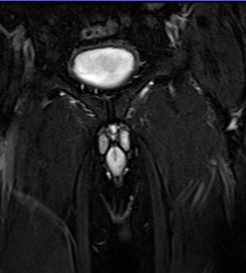 mri penis coronal  t2 stir  image 