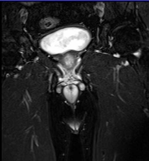 mri penis coronal  t2 stir  image 