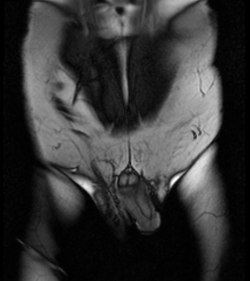 mri penis coronal localizer