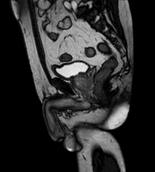 mri penis sagittal localizer