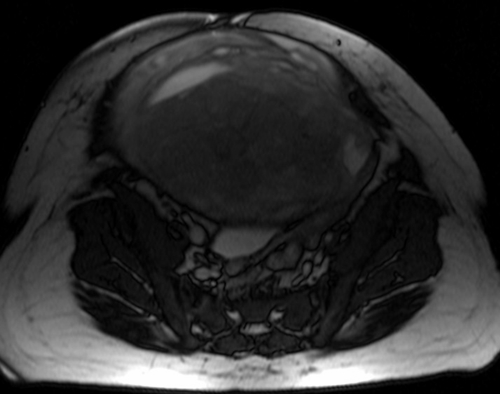 mri placenta placenta accreta axial oblique t2 trufi  image