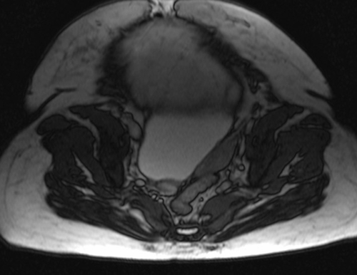 mri placenta placenta previa axial oblique t2 trufi  image