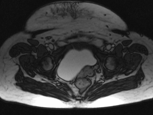 mri placenta placenta previa axial oblique t2 trufi  image