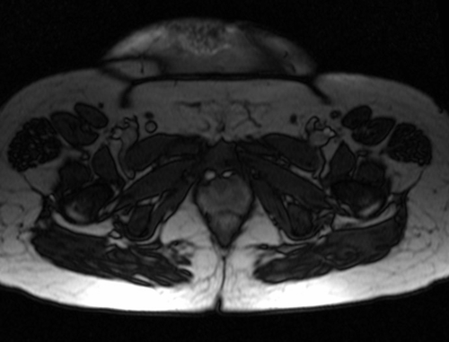 mri placenta placenta accreta axial oblique t2 trufi  image