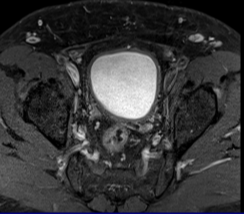 Prostatectomy patients prostate MRI T1 fat sat post contrast axial high resolution images 