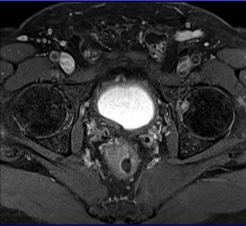 Prostatectomy patients prostate MRI T1 fat sat post contrast axial high resolution images