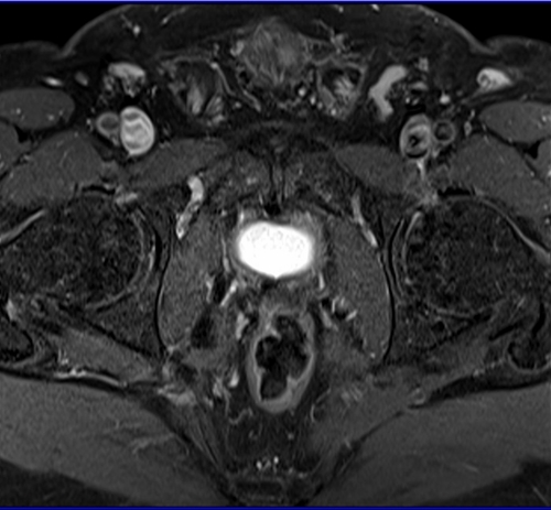 Prostatectomy patients prostate MRI T1 fat sat post contrast axial high resolution images 