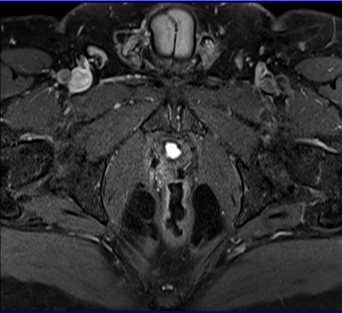 Prostatectomy patients prostate MRI T1 fat sat post contrast axial high resolution images 