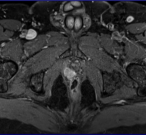 Prostatectomy patients prostate MRI T1 fat sat post contrast axial high resolution images