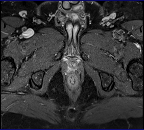 Prostatectomy patients prostate MRI T1 fat sat post contrast axial high resolution images 