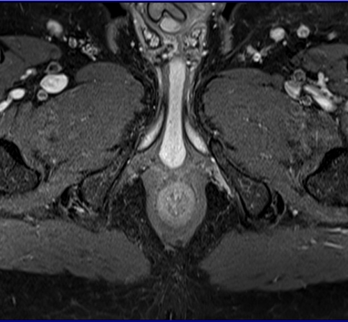 Prostatectomy patients prostate MRI T1 fat sat post contrast axial high resolution images