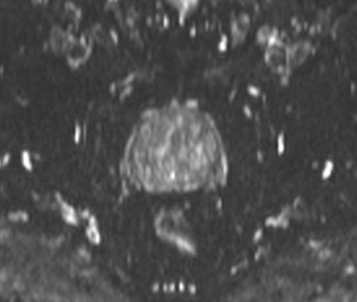 pelvis prostate  dwi axial b0 image 