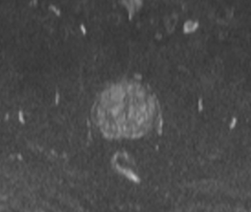 pelvis prostate  dwi axial b500  image 