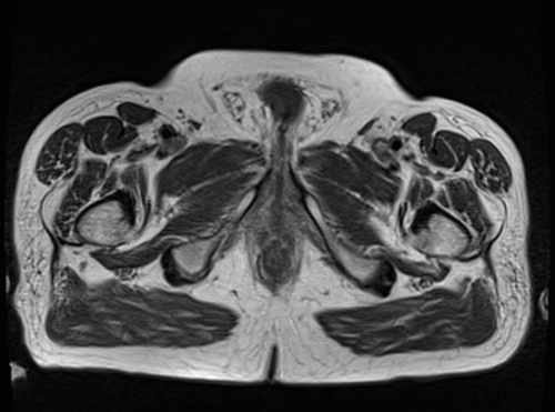 MRI pelvis prostate axial  t1 axial  image 