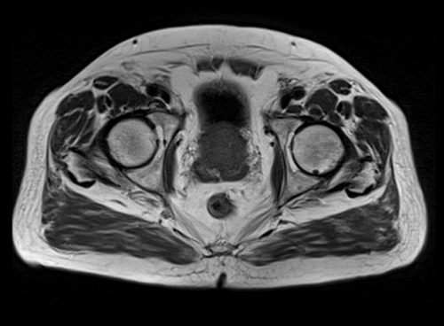 MRI pelvis prostate axial  t1 axial  image 