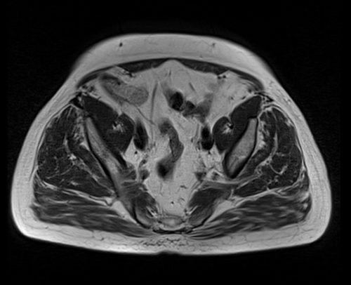 MRI pelvis prostate axial  t1 axial  image 