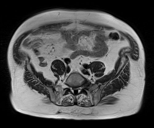 MRI pelvis prostate axial  t1 axial  image 