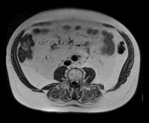 MRI pelvis prostate axial  t1 axial  image 