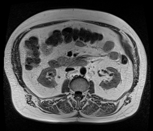 MRI pelvis prostate axial  t1 axial  image 