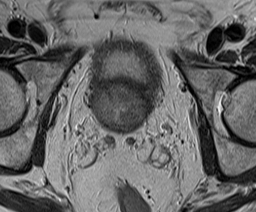 MRI pelvis prostate axial  t2 high resolution image 