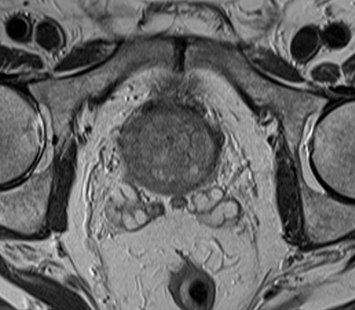 MRI pelvis prostate axial  t2 high resolution image 