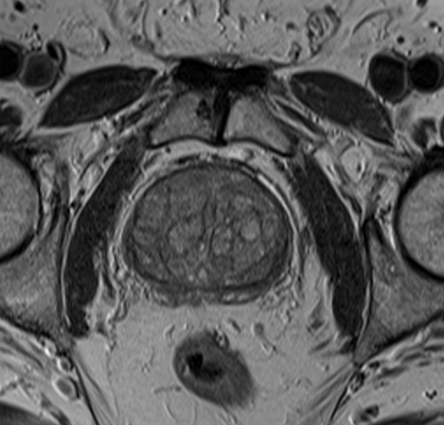 MRI pelvis prostate axial  t2 high resolution image 