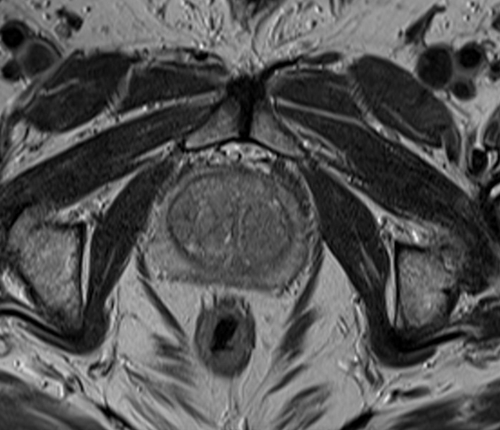 MRI pelvis prostate axial  t2 high resolution image 