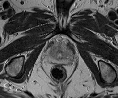 MRI pelvis prostate axial  t2 high resolution image 