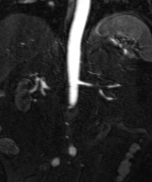 mri renal agiography (MRA renal arteries) coronal t1 flash post  contrast image