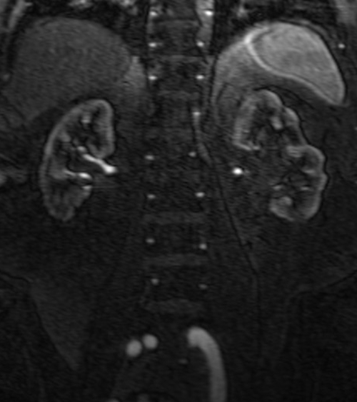 mri renal agiography (MRA kidneys) coronal t1 flash post  contrast image