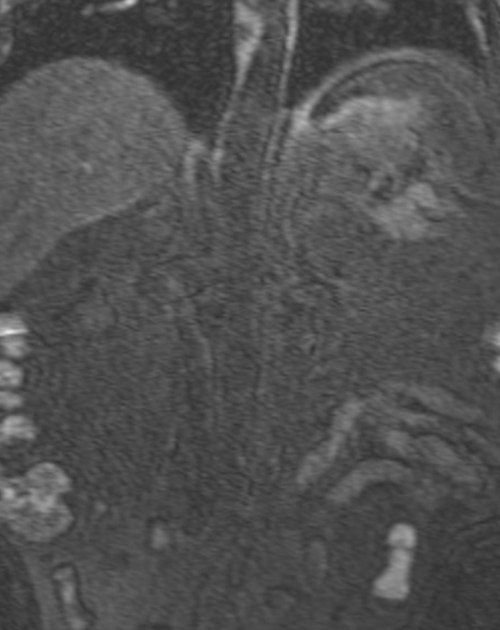 mri renal agiography coronal t1 flash pre contrast image