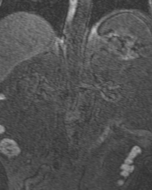 mri renal agiography (MRA kidneys) coronal t1 flash pre contrast image