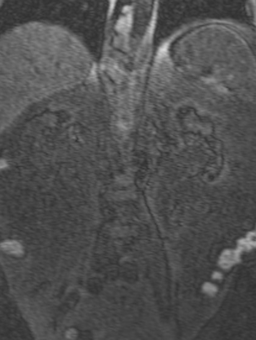 mri renal agiography (MRA renals)coronal t1 flash pre contrast image