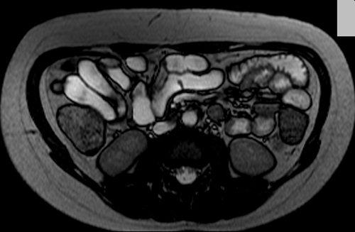 ri enteroclysis  axial trufi image