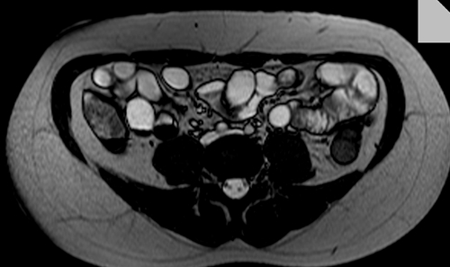 ri enteroclysis  axial trufi image