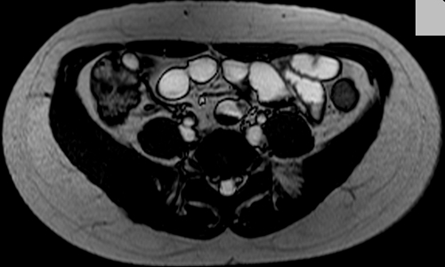 ri enteroclysis  axial trufi image