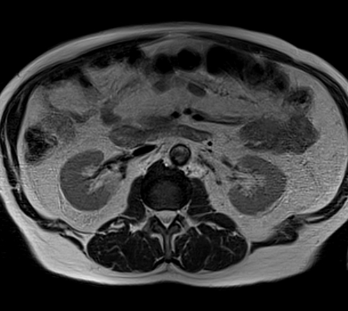 MRI testis big fov axial t2 image (mri of testicles)