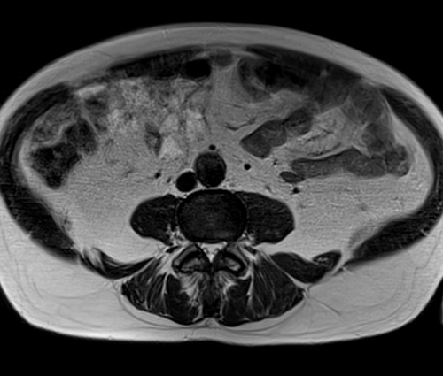 MRI testis big fov axial t2 image (mri of testicles)