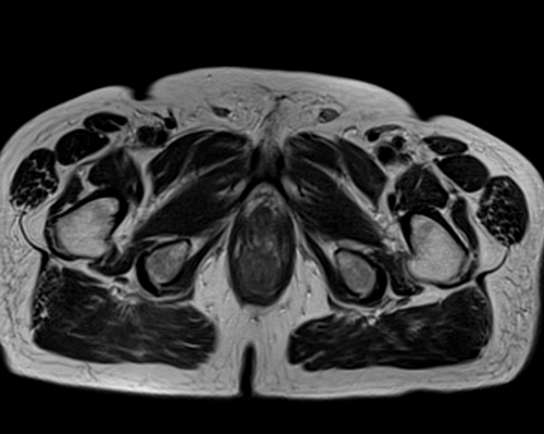 MRI testis big fov axial t2 image (mri of testicles)