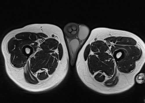 MRI testis big fov axial t2 image (mri of testicles)