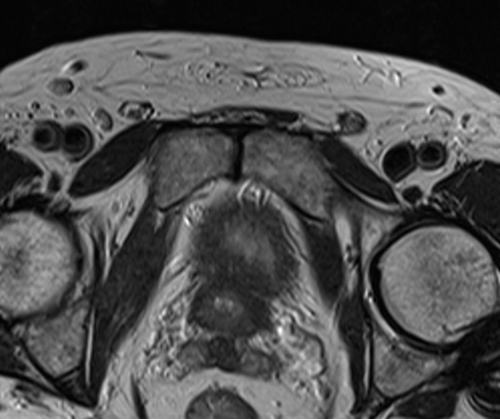 MRI testis axial t2 high resolution images(mri of testicles)