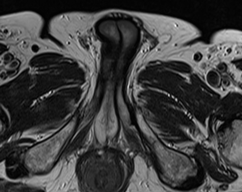 MRI testis axial t2 high resolution images(mri of testicles)